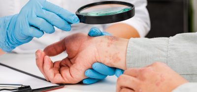 Psoriasis Treatment
