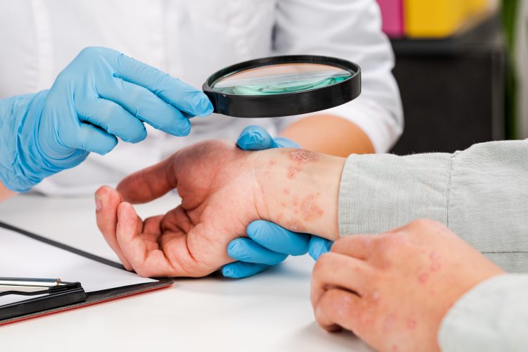Psoriasis Treatment