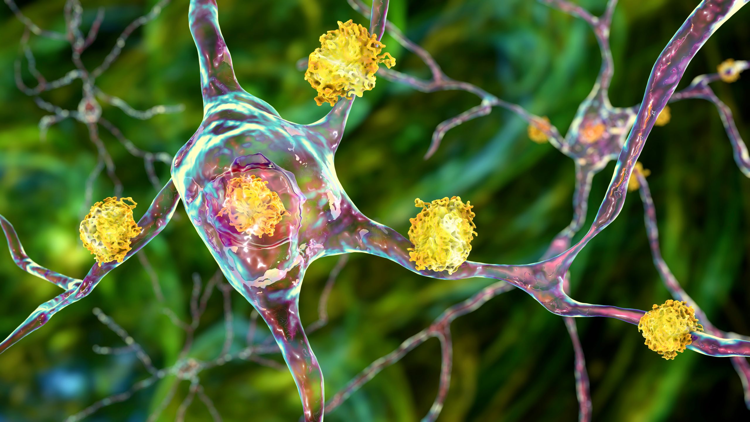 Neuronal inclusions in Huntington's disease, 3D illustration. Inclusions are composed of mutated huntingtin protein, they are initially formed at axons and dendrites, then migrate to nuclei of neurons